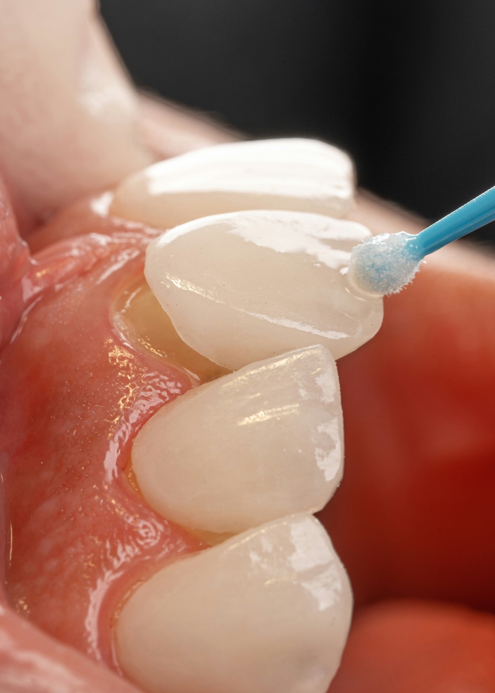 Evaluación de color para carillas dentales